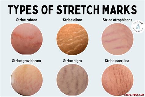 Why Stretch Marks Itch: Exploring the Mysteries of Skin's Silent Whispers